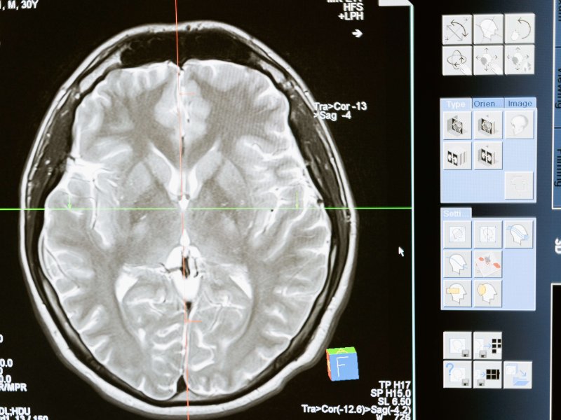 get a brain scan after a traumatic brain injury