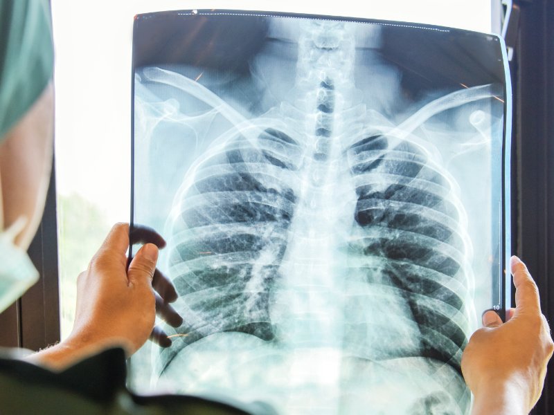 doctor holding xray of lungs