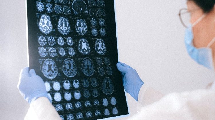 doctor looking at brain scan for traumatic brain injury