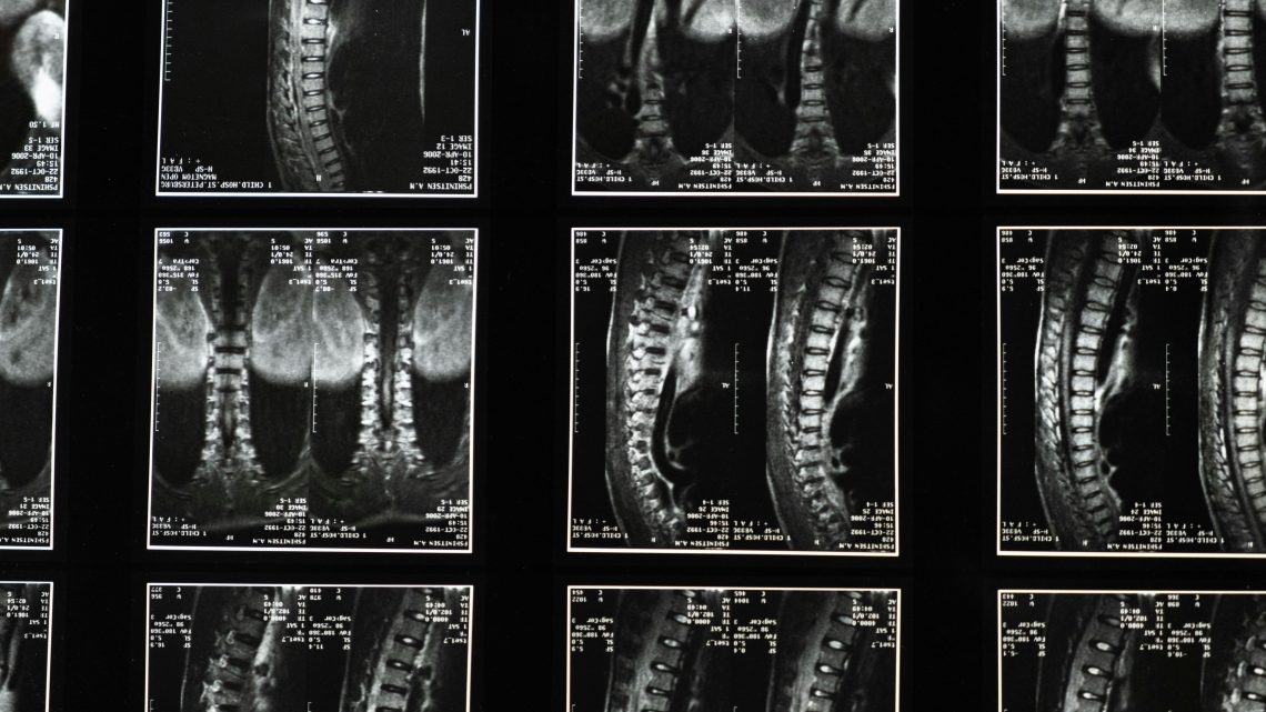 spinal cord injury x-rays